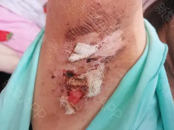 氧气wjs4a2f手术除腋臭第17天美丽日记