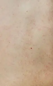 疥疮症状荨麻疹的人的腹部照片