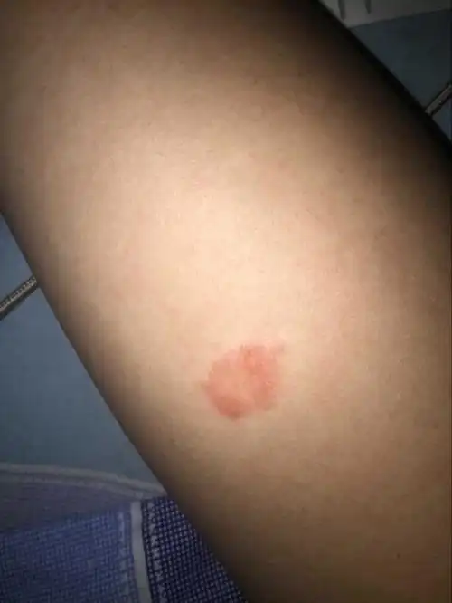 大腿上起红斑 痒的不行谁知道是什么么