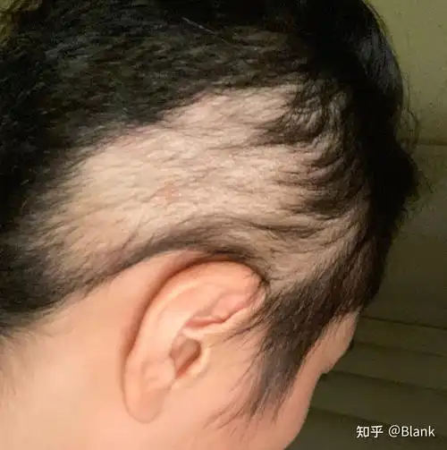 拔毛癖真的没办法戒掉吗? - 知乎