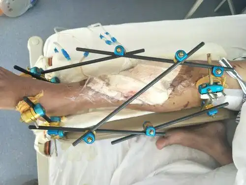 男子腿部受伤严重必须截肢?沈阳积水潭医院决定这么做.
