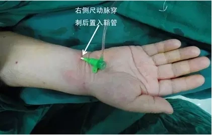 冠脉血管支架是怎么放的? - 好大夫在线