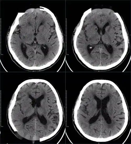 67超急性期大面积脑梗死ct平扫表现