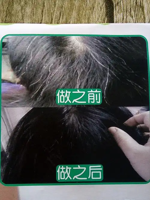 白发到黑发前后对比中