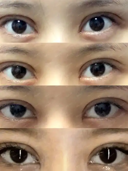 我是今年夏天割的双眼皮,传说夏天不适合割双眼皮,亲身经历并不是这样