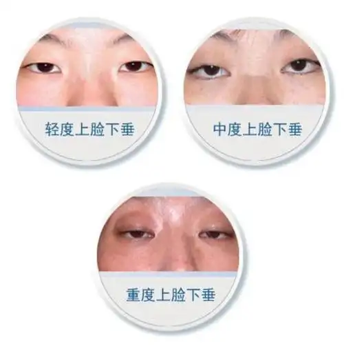 假性上睑下垂教你判断你是否眼睑下垂_上睑下垂_上