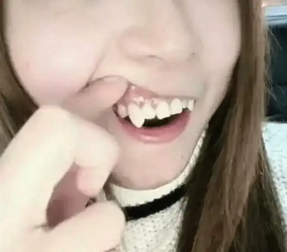 虎牙又叫犬齿,是一种常见的畸形牙,指唇侧错位的尖牙(上颌的两颗单