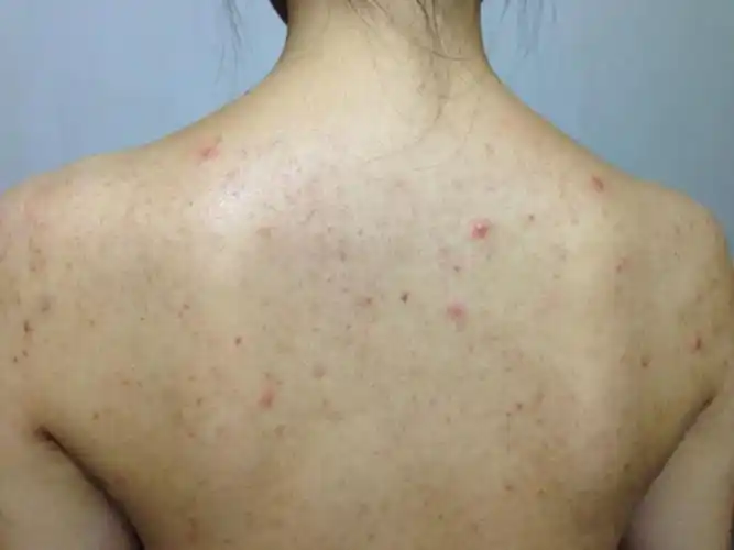 第二种,如果是毛囊炎类,细菌性毛囊炎症状较轻的可以局部外用莫匹罗星