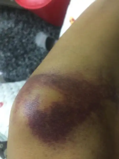 麻烦懂跌打损伤的朋友帮我看看,摔了一跤,之前肿很大,现在稍微小一点