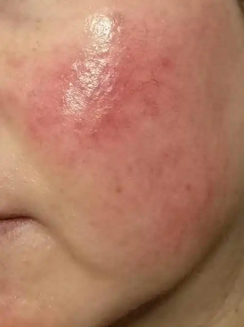 从小就有的红血丝很严重的不要担心