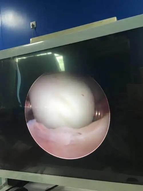 (丽妮)节育环嵌顿于子宫肌瘤顺利取出