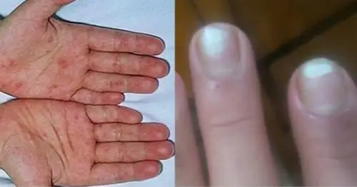 手掌出现「它」,代表罹患「肝癌」机率大!快检查看看你有吗?