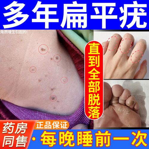 水杨酸软膏 扁平疣专药 去看疣灵扁平疣面部用药脖子瘊子脂肪粒趾疣肉