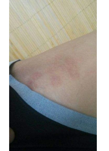 体股癣初期现象图片8