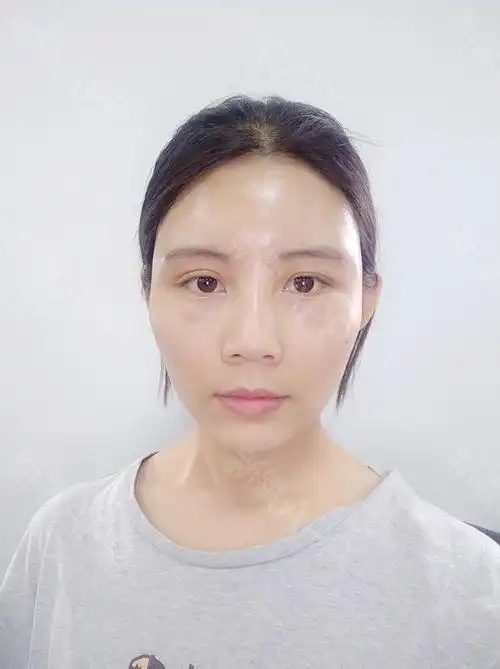 【自体脂肪全脸填充第5天】脂肪填充后能够促进我们的_圈子-新氧美容