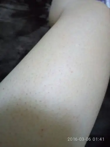 我的腿上都是这种点点的 是毛孔堵塞吗 怎么办好