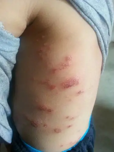 弟弟的小孩子全身瘙痒,皮肤都抓破啦,打针吃药都不见有效.