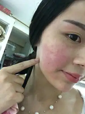 红血丝篇冬季护肤脸部皮肤泛红发烫怎么办