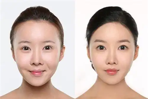 发际线种植哪家医院好揭秘jp与多娜技术特色