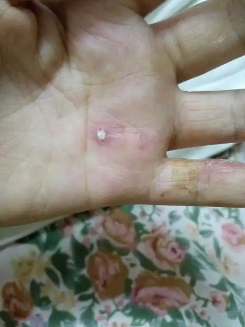 白色处是我挑破用消毒水弄得,其余两个针眼处有硬包,是发炎了吗