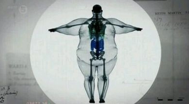 巅峰减肥中心:骨架越大,未必就越胖