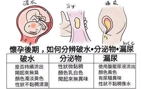 秒懂妇幼孕晚期如何区分破水漏尿和阴道分泌物
