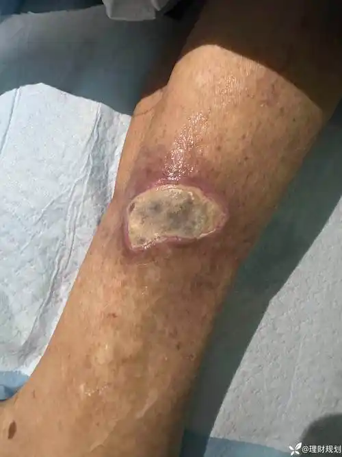 去甲肾上腺素造成皮肤坏死