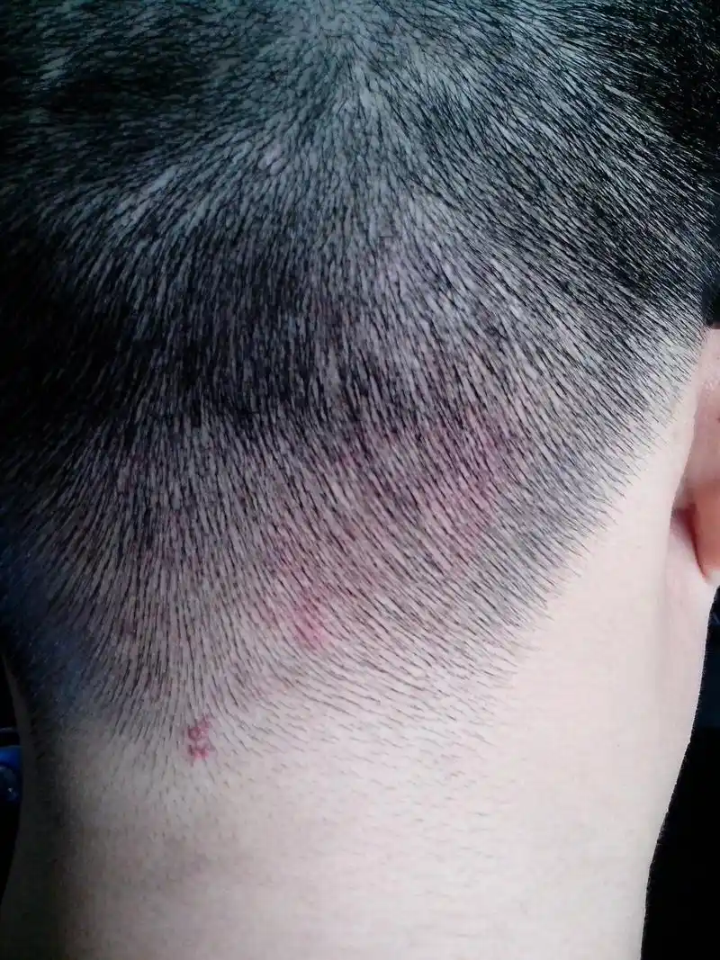 头皮上长成片的小红疙瘩 很痒 挠后很疼 破溃 痛苦不已 求大家帮助