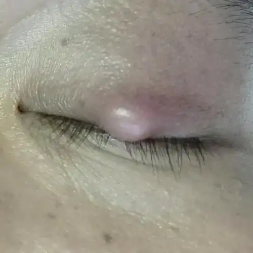 睑板腺囊肿