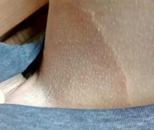大腿根部中度股癣 局部 图片_有来医生