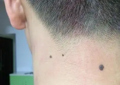 男人脖子后面痣分析图,男人脖子后面有痣图解