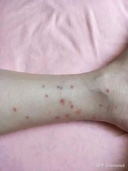 跳蚤咬了怎么办