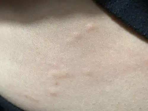 【讨论】请问这个是被螨虫或者跳蚤咬的包吗 身上好.