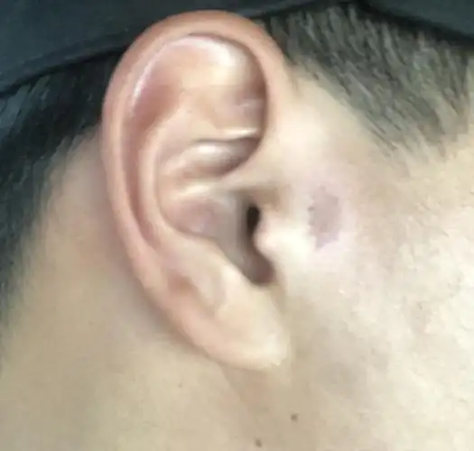 耳朵边上这一块皮干了已经一个月了痒痒的这是怎么回事啊