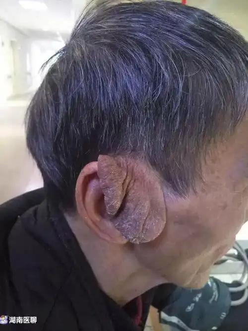 老人耳朵后面起了个疙瘩(老人长三只耳朵)(1)
