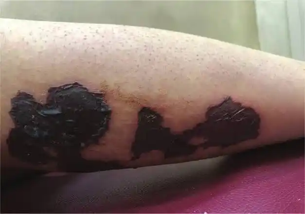 吃华法林的皮肤坏死,你身边有朋友经历么?