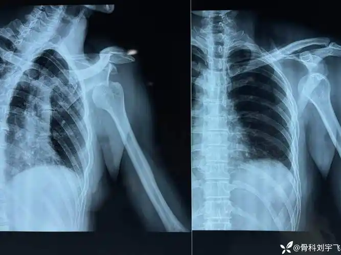 视频教学:简单实用"外展外旋法"复位肩关节前脱位