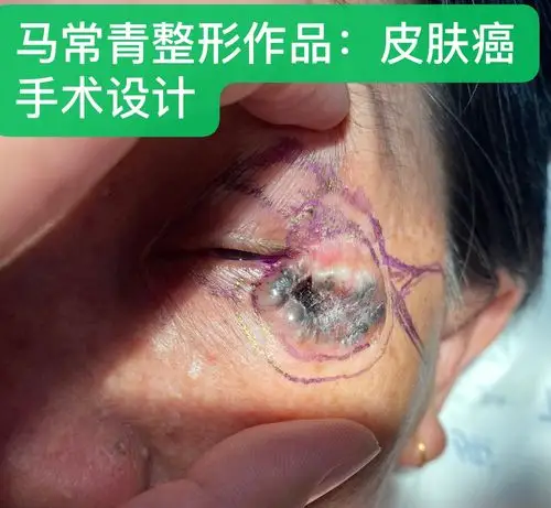 皮肤肿瘤整形美容科普