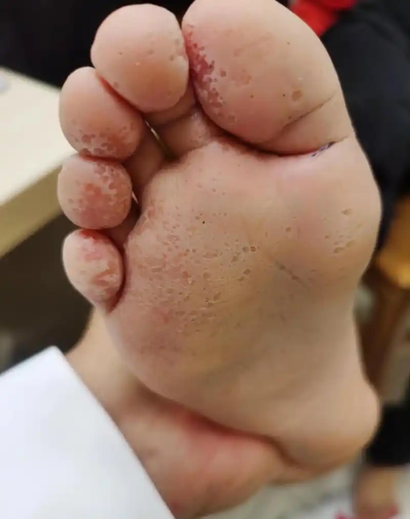 小朋友踢足球,晚上洗脚发现脚底全是这种小坑坑,以为就是脚气,涂