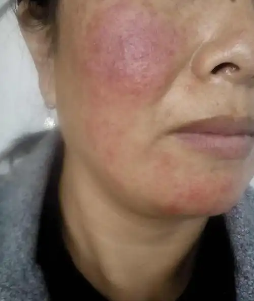 皮肤屏障是什么?