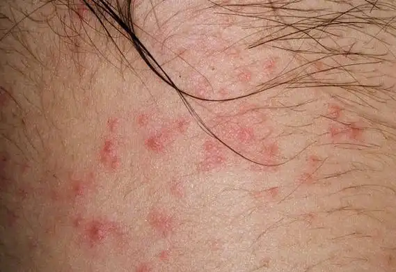 如何区分湿疹和艾滋病从三方面入手