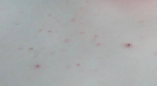 钱医生你好,胸前最开始起了很多红色的小点点,不疼也不痒,现在