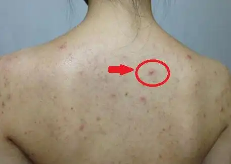 螨虫侵入毛囊,引发炎症,例如螨虫侵入睫毛毛囊内和皮脂腺内,可造成眼