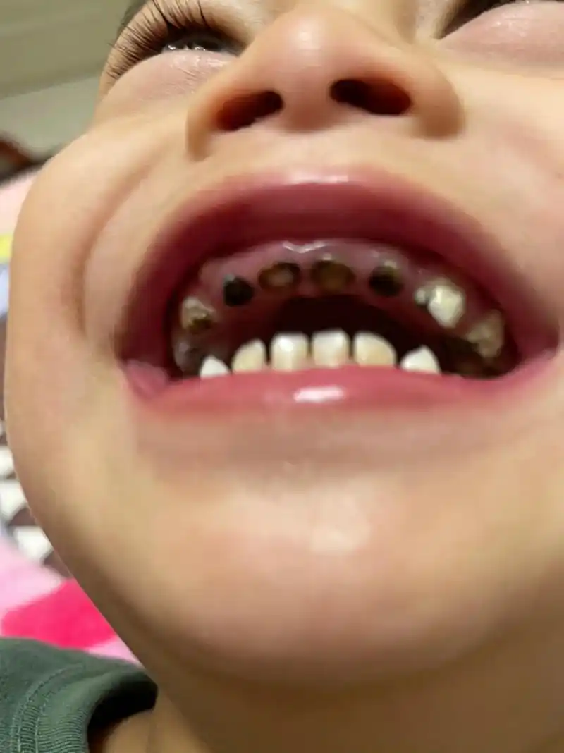 刚三周的儿子96,上排牙齿全部坏了096995,下排大牙齿一侧