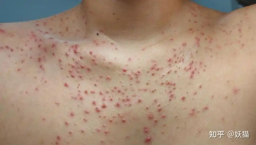 马拉色菌毛囊炎的治愈全过程亲身经历图片可能引起不适请谨慎观看