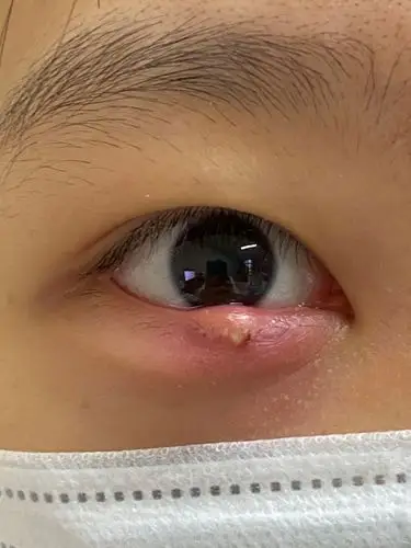 认识睑板腺疾病(上)_麦粒肿_介绍_症状表现_如何预防_治疗方式 - 好