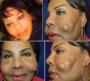 自体脂肪填充有害吗谨记"四不做"