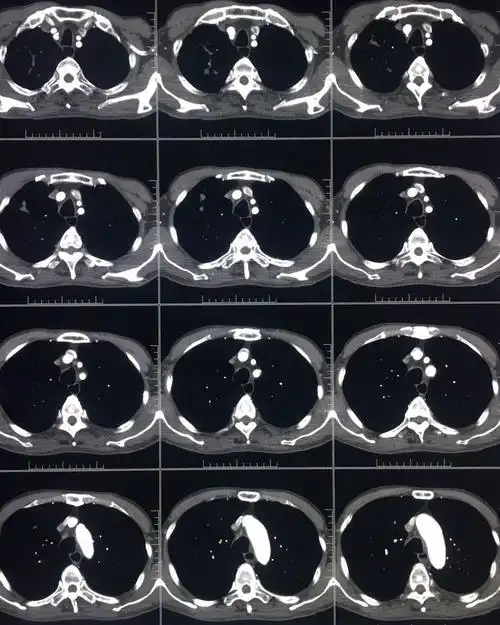 ct平扫 三期增强,这个纵隔占位有点难 [病例帖]