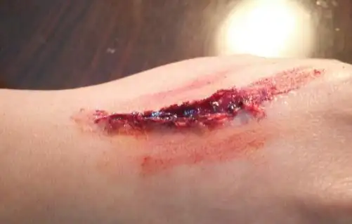 致命的破伤风注意防治并发症 伤口处理很重要