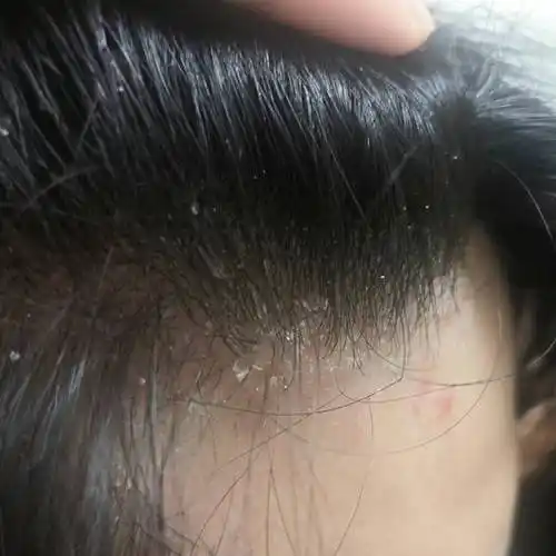 头皮屑_去屑_问题